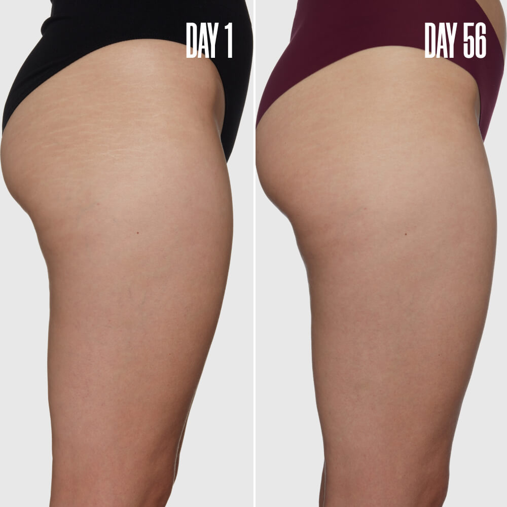 Outer Thigh Stretch Mark Cream product